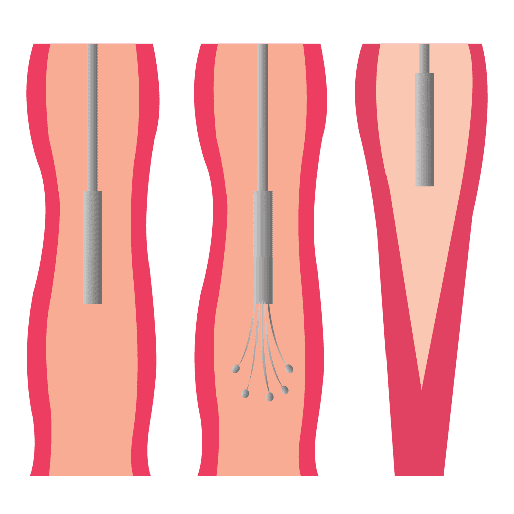Ablación endovenosa