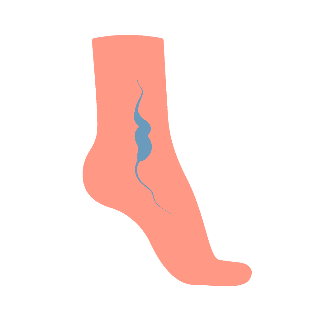 Miniflebectomía